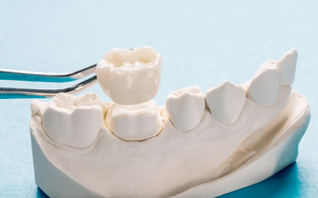 Coroas dentárias