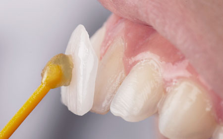 Facetas dentárias