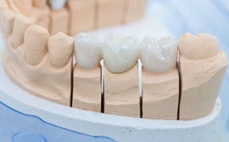 Pontes dentárias